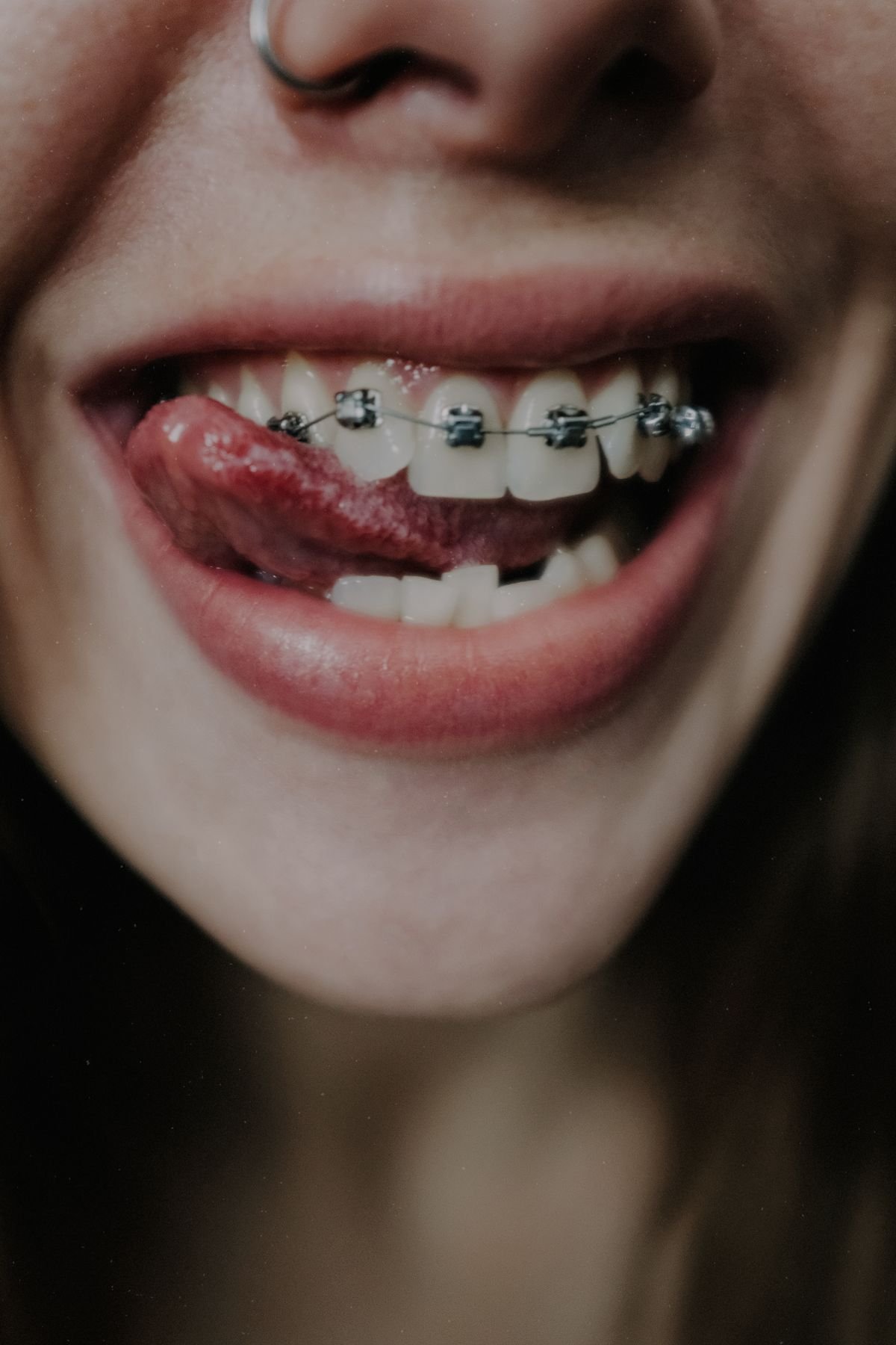 Braces at AJ Beauty and Spa